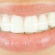 closeup_smile_clearbow_retainer_96