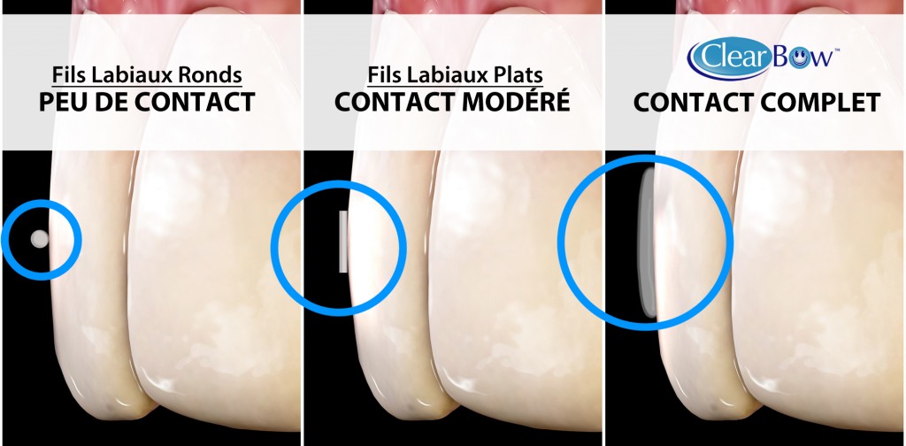 clearbow_contact_avec_les_dents_96_french